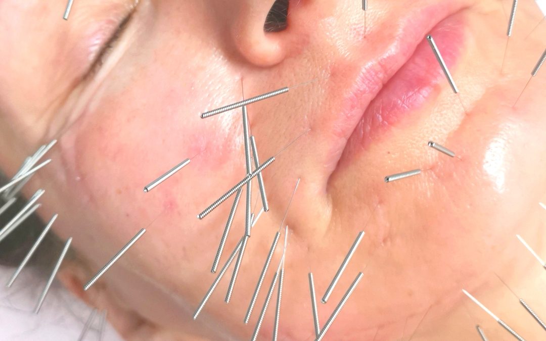 AKUPUNKTURA ESTETYCZNA